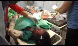 जंगल की आग घर तक पहुंची, बुझाने के दौरान महिला झुलसी