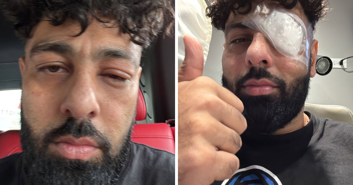Badshah Eye Injury