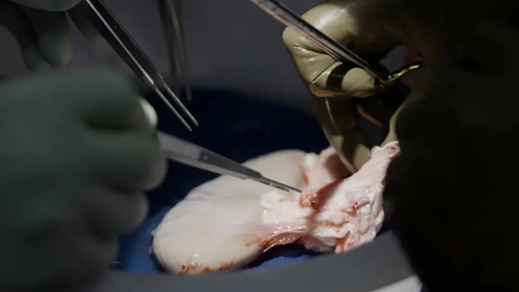 What Is a Pig Kidney Transplant?
